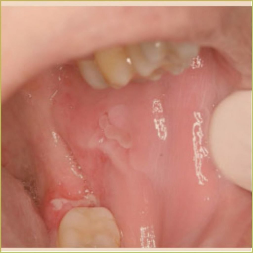 Crohns Disease 1 1024x1024 1