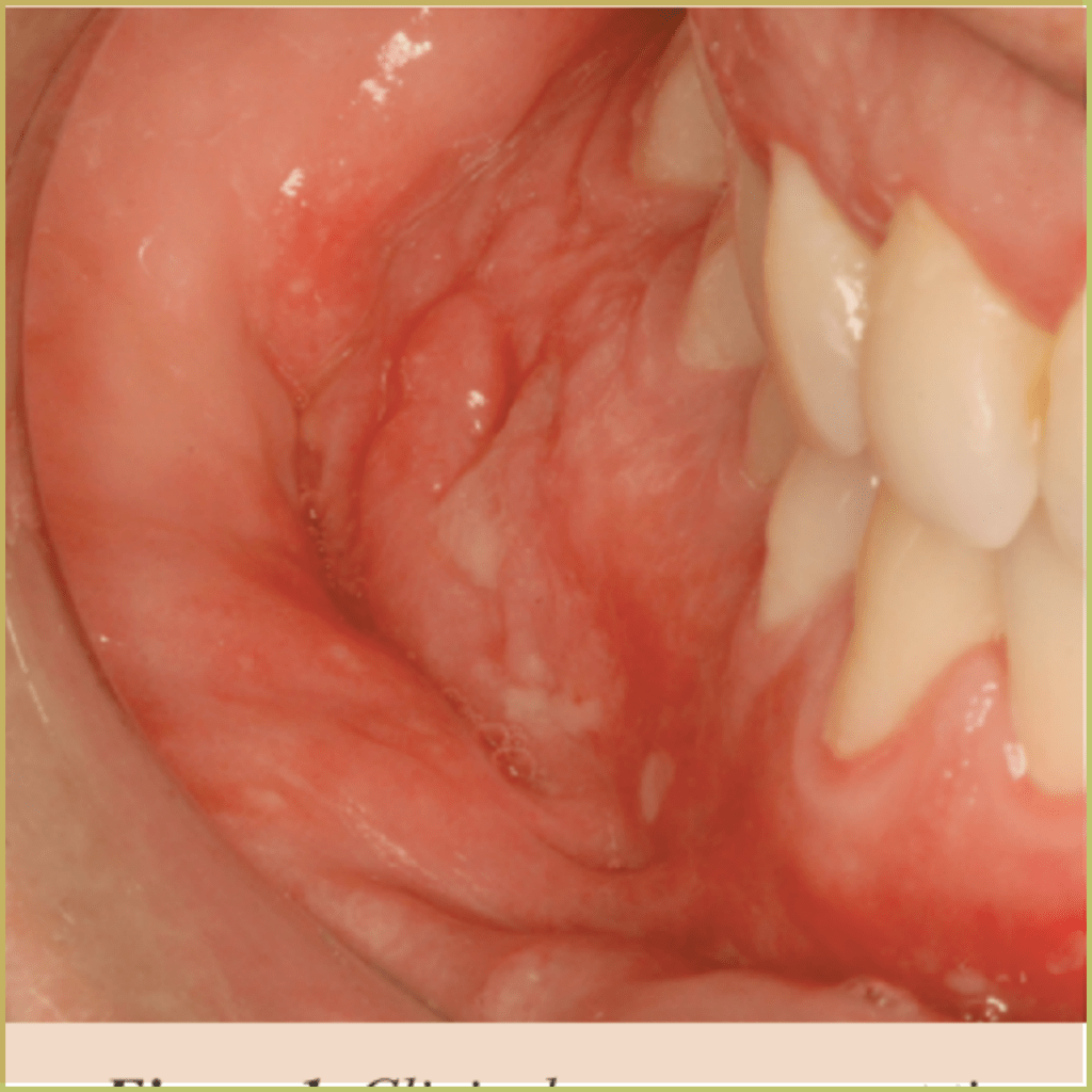 Crohns Disease 2 1024x1024 1