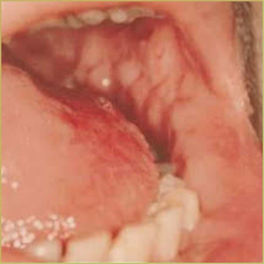 Crohns Disease 3 1024x1024 1