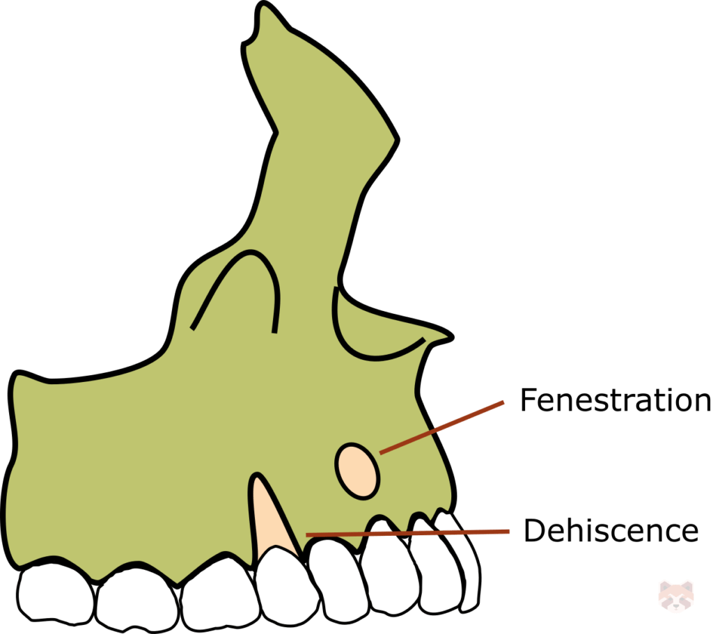 Dehiscence 1024x911 1