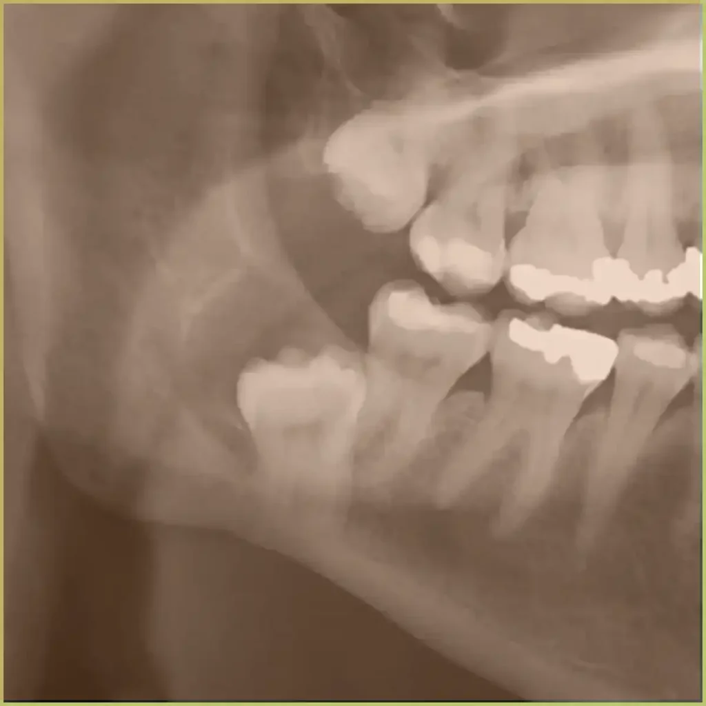 Dentigerous Cyst 2