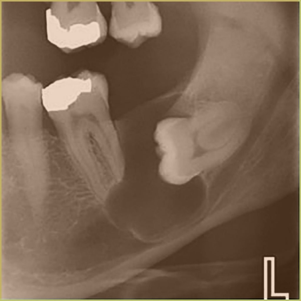 Dentigerous Cyst 3 1024x1024 1