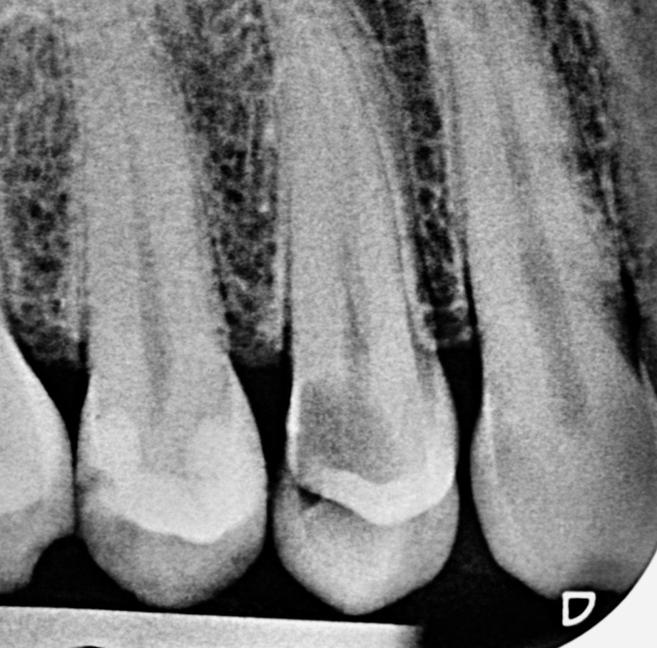 Distal caries