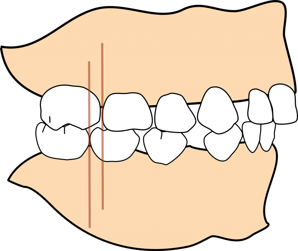 Distal step 1024x862 1