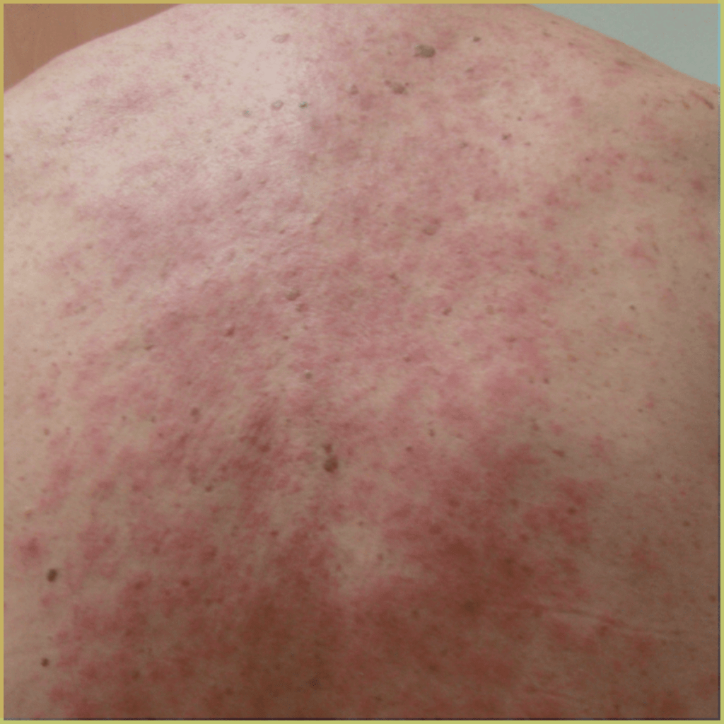 Drug induced lichen planus 1 1024x1024 1