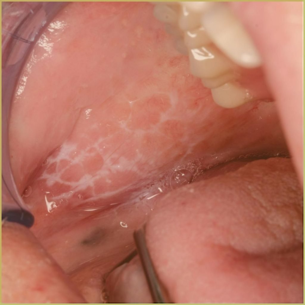 Drug induced lichen planus 2 1024x1024 1