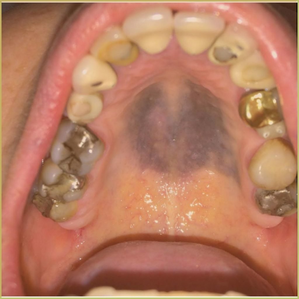 Drug induced pigmentation 1 1024x1024 1