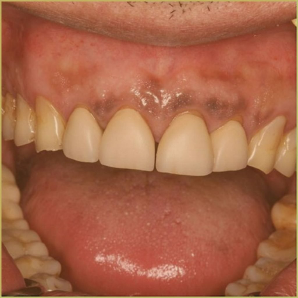 Drug induced pigmentation 2 1024x1024 1