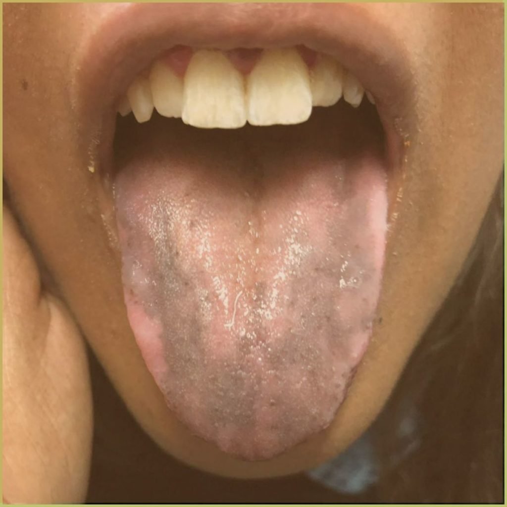 Drug induced pigmentation 3 1024x1024 1