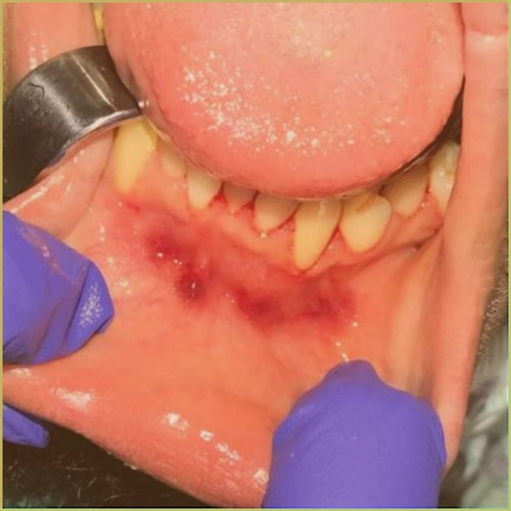 Ecchymosis 1 1024x1024 1