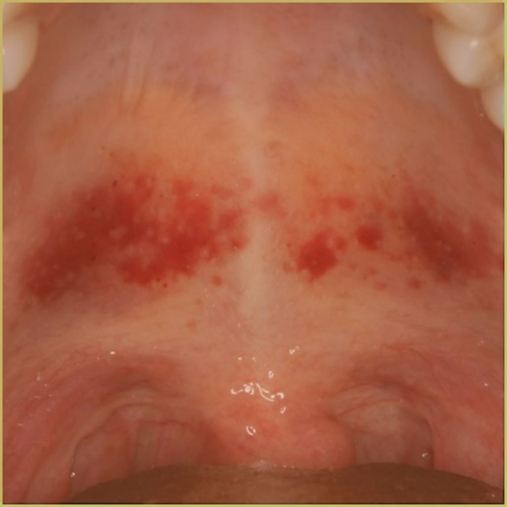 Ecchymosis 2 1024x1024 1