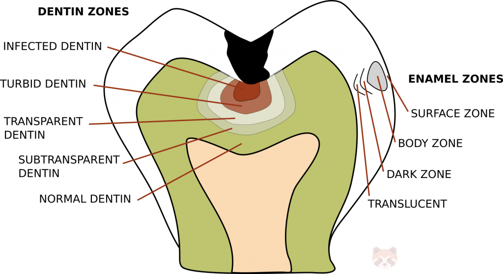 Enamel and dentine caries zones 1024x559 1