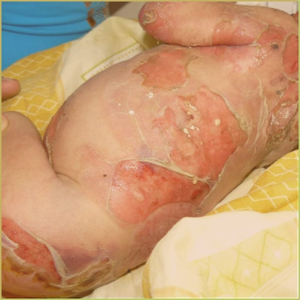 Epidermolysis Bullosa 1 1024x1024 1