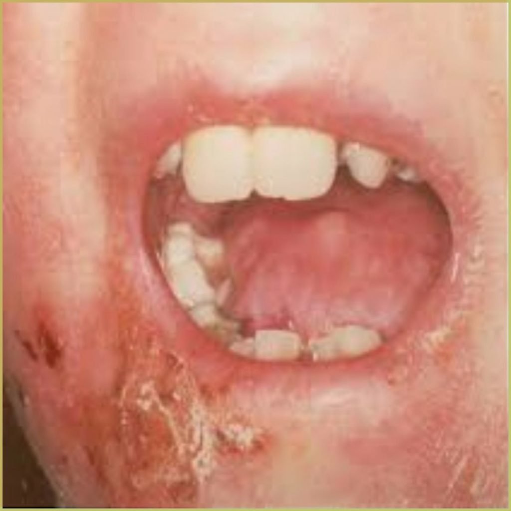 Epidermolysis Bullosa 2 1024x1024 1