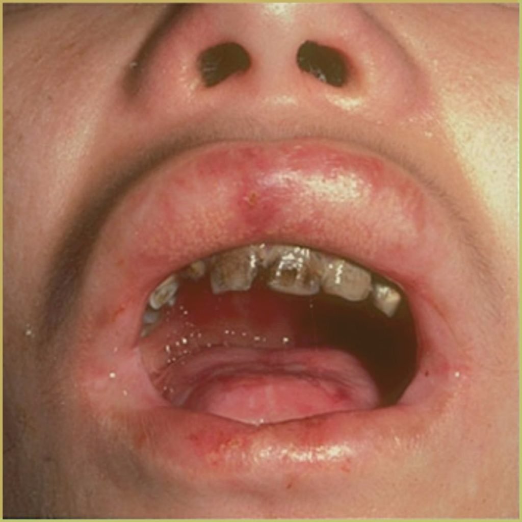 Epidermolysis Bullosa 3 1024x1024 1