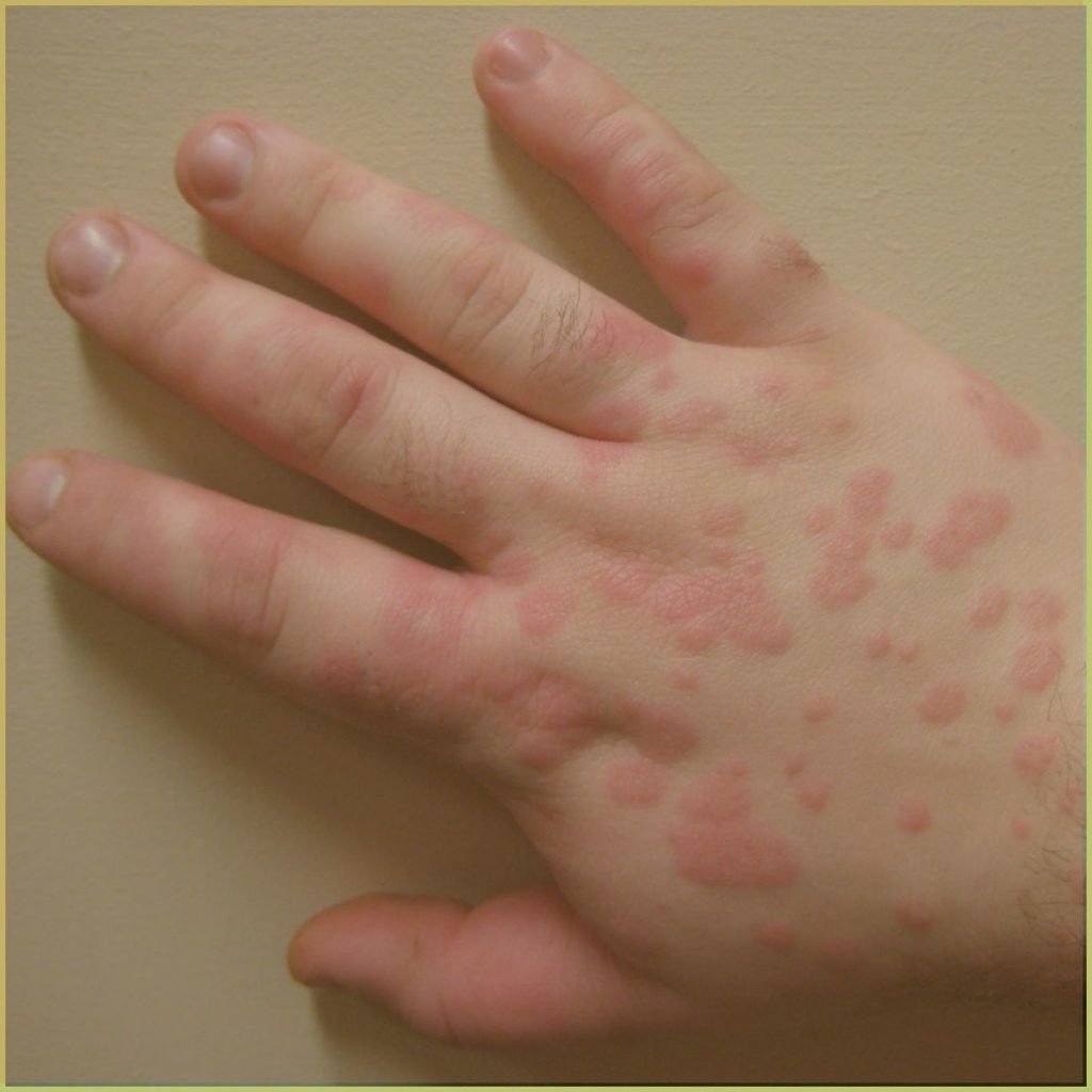 Erythema Multiforme 1 1024x1024 1