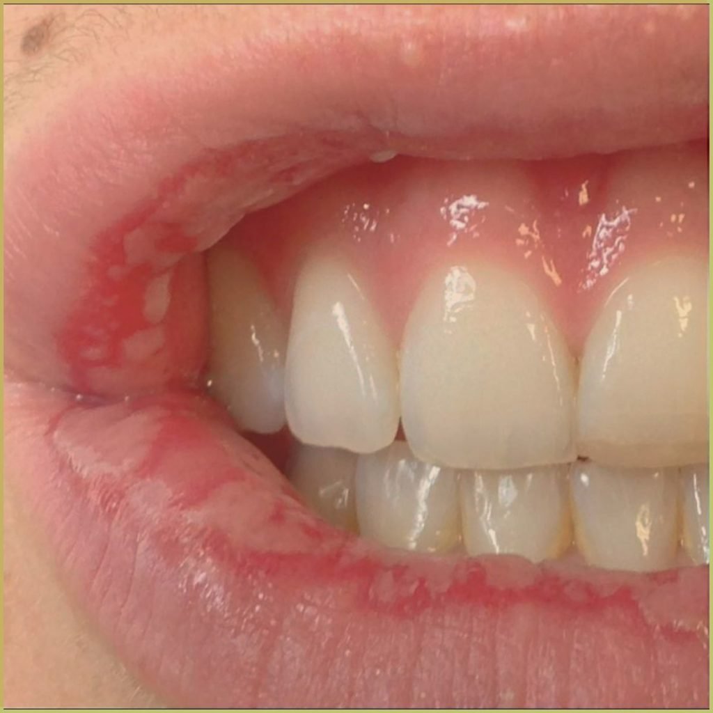 Erythema Multiforme 3 1024x1024 1