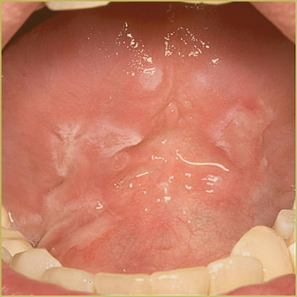 Erythema Multiforme 4 1024x1024 1