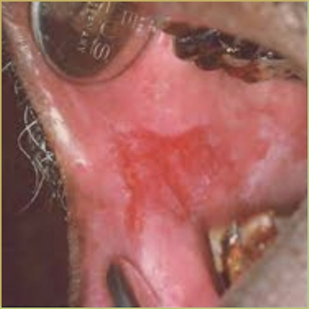 Erythroplakia 1 1024x1024 1