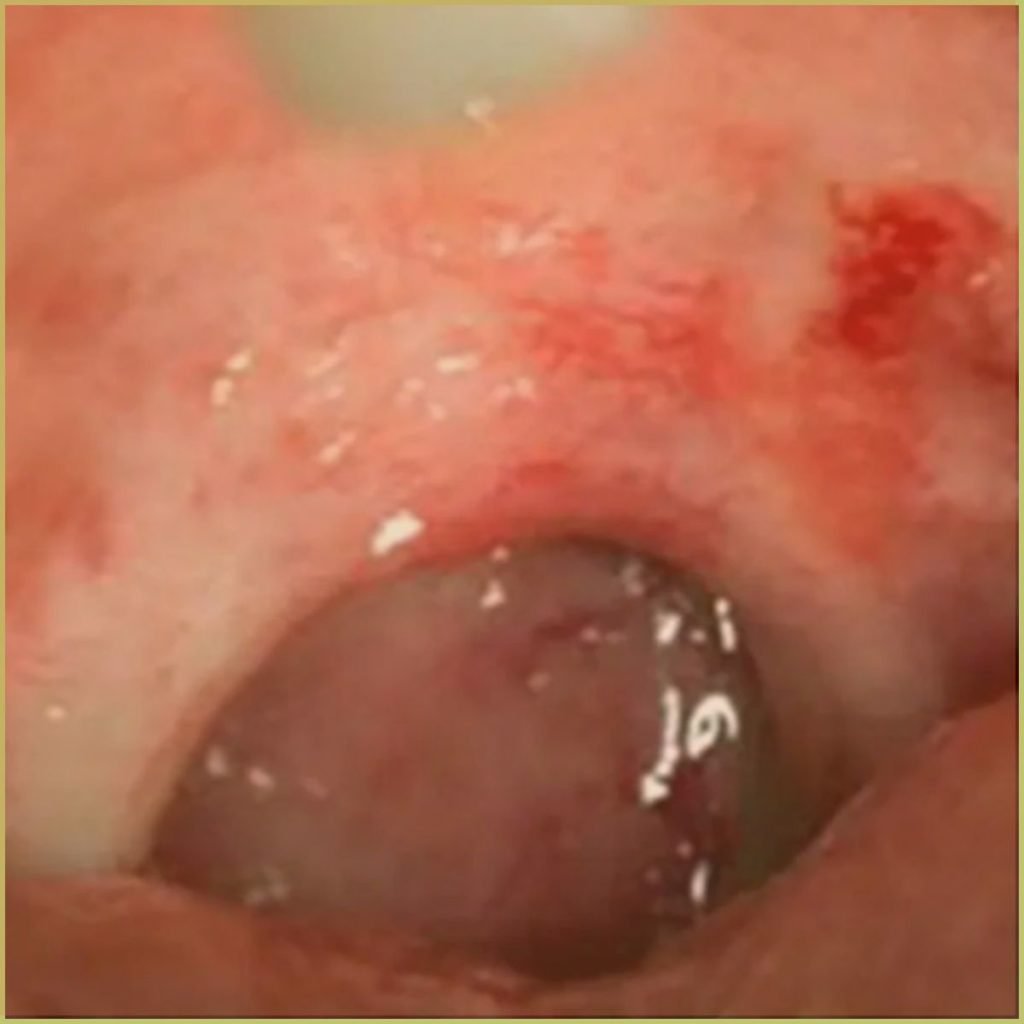 Erythroplakia 2 1024x1024 1