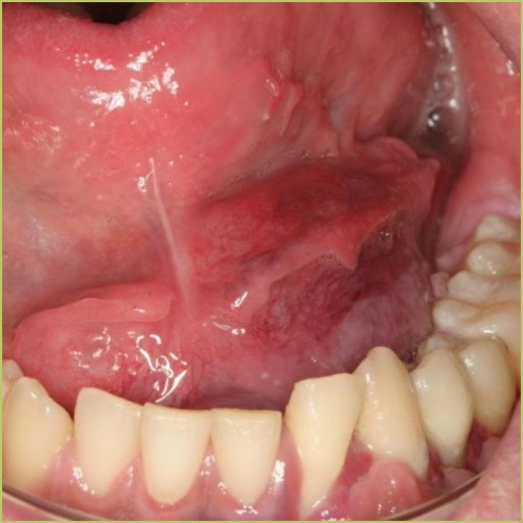 Ewings Sarcoma1 1024x1024 1