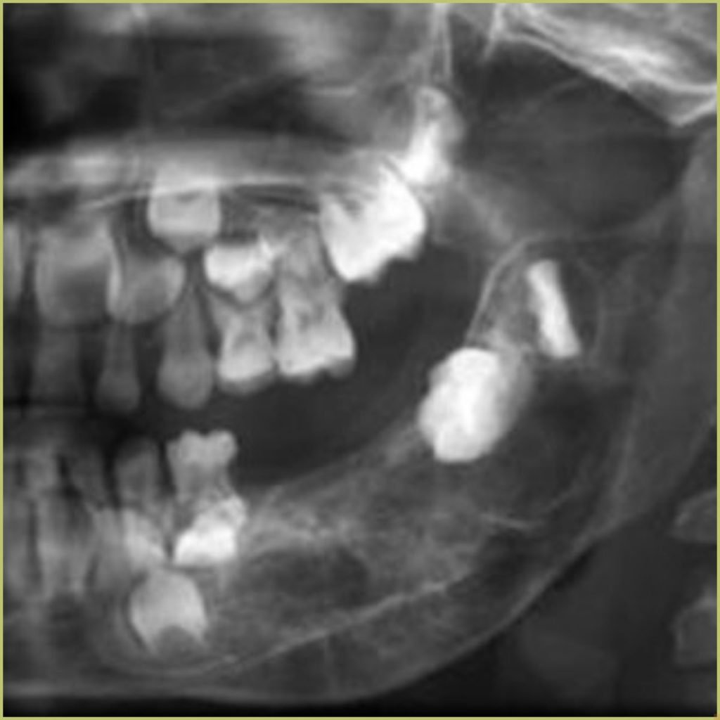 Ewings Sarcoma2 1024x1024 1