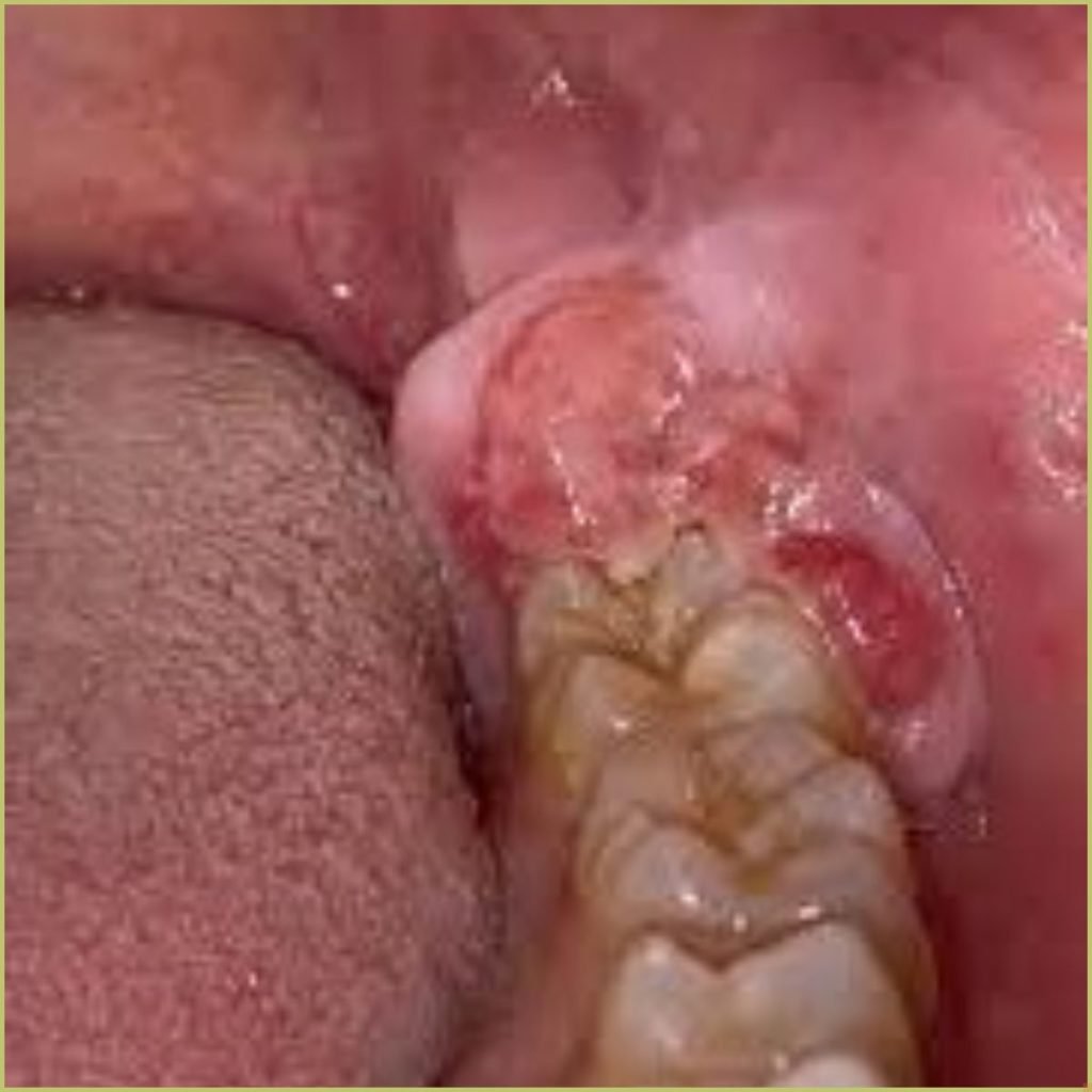 Ewings Sarcoma3 1024x1024 1