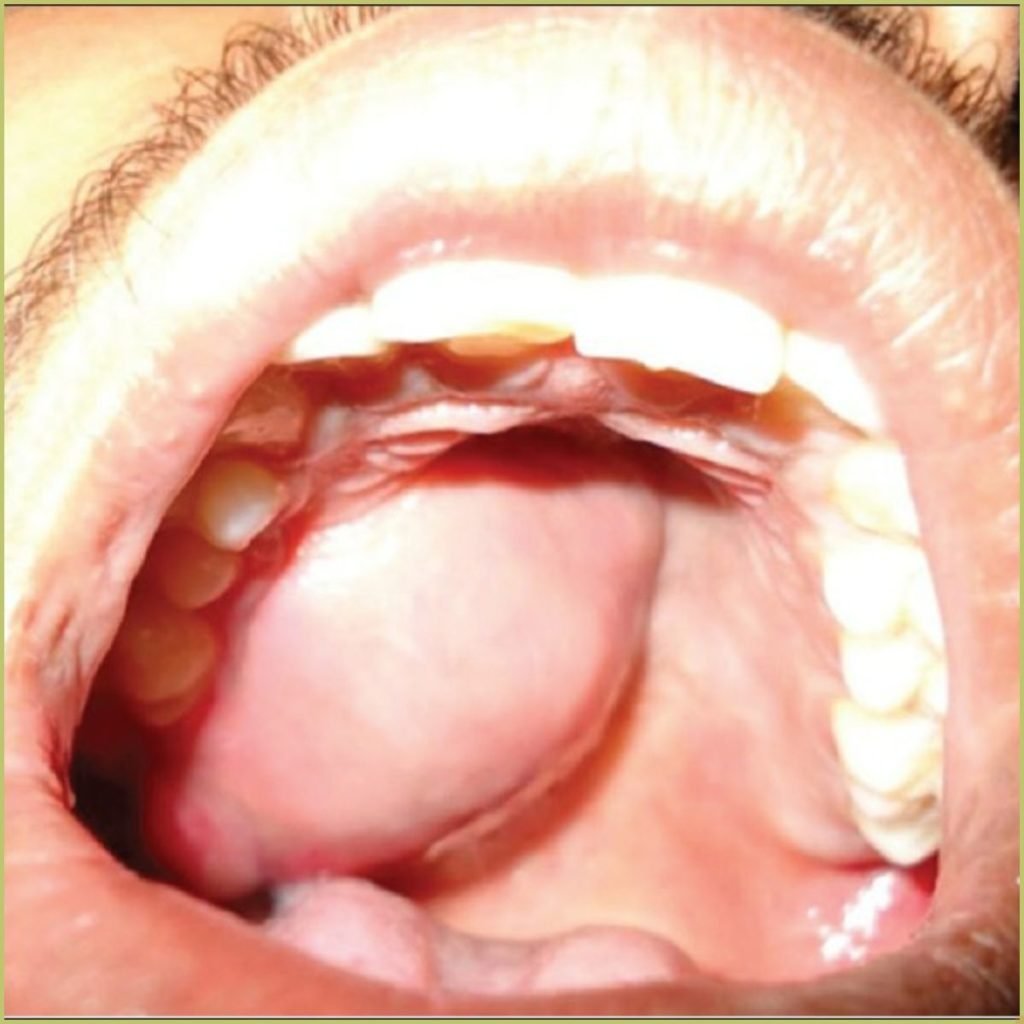 Ewings Sarcoma4 1024x1024 1