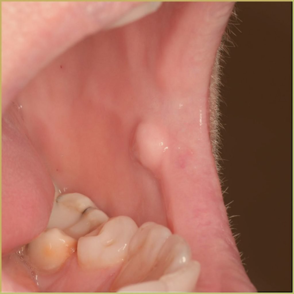 Fibroma 1 1024x1024 1