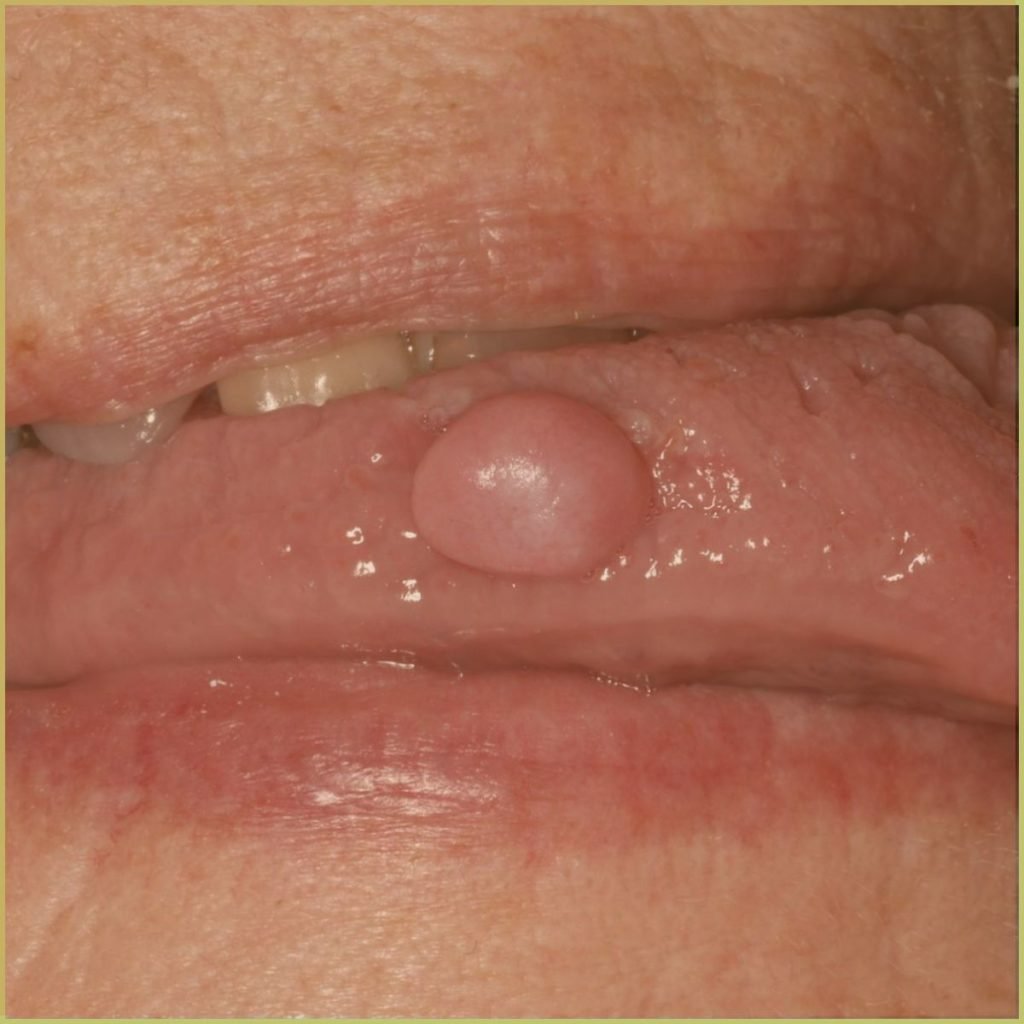 Fibroma 4 1024x1024 1