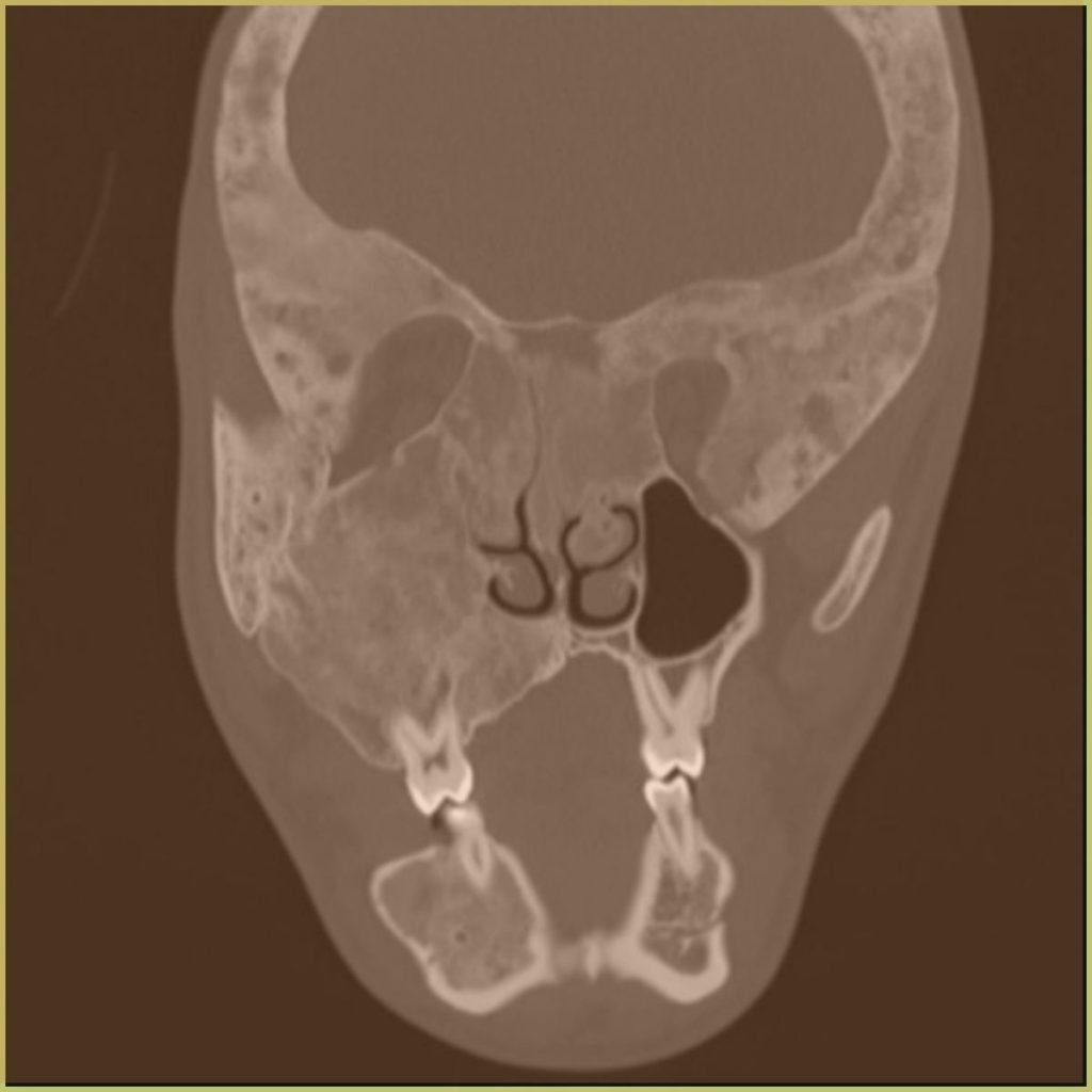Fibrous Dysplasia 1 1024x1024 1