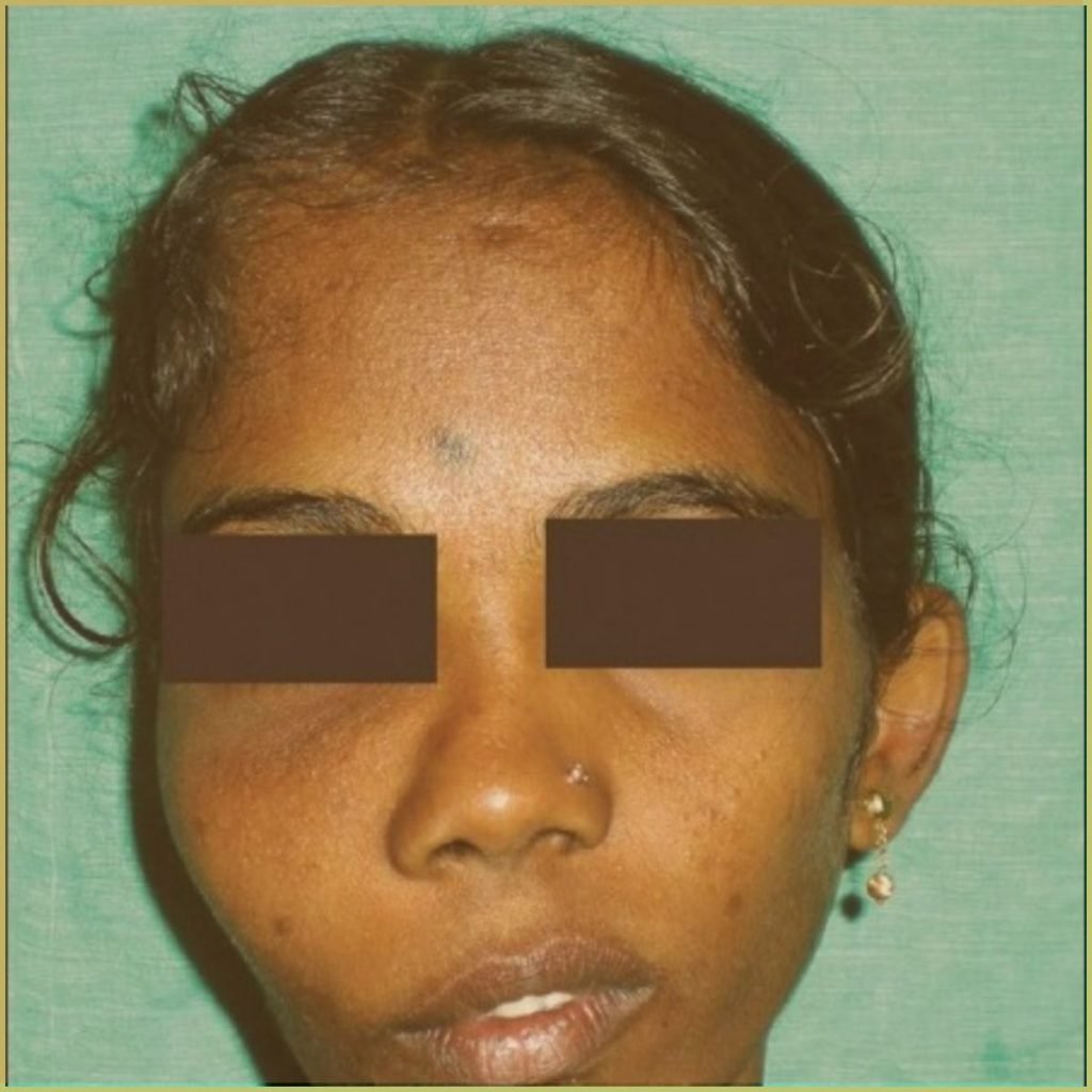 Fibrous Dysplasia 4 1024x1024 1