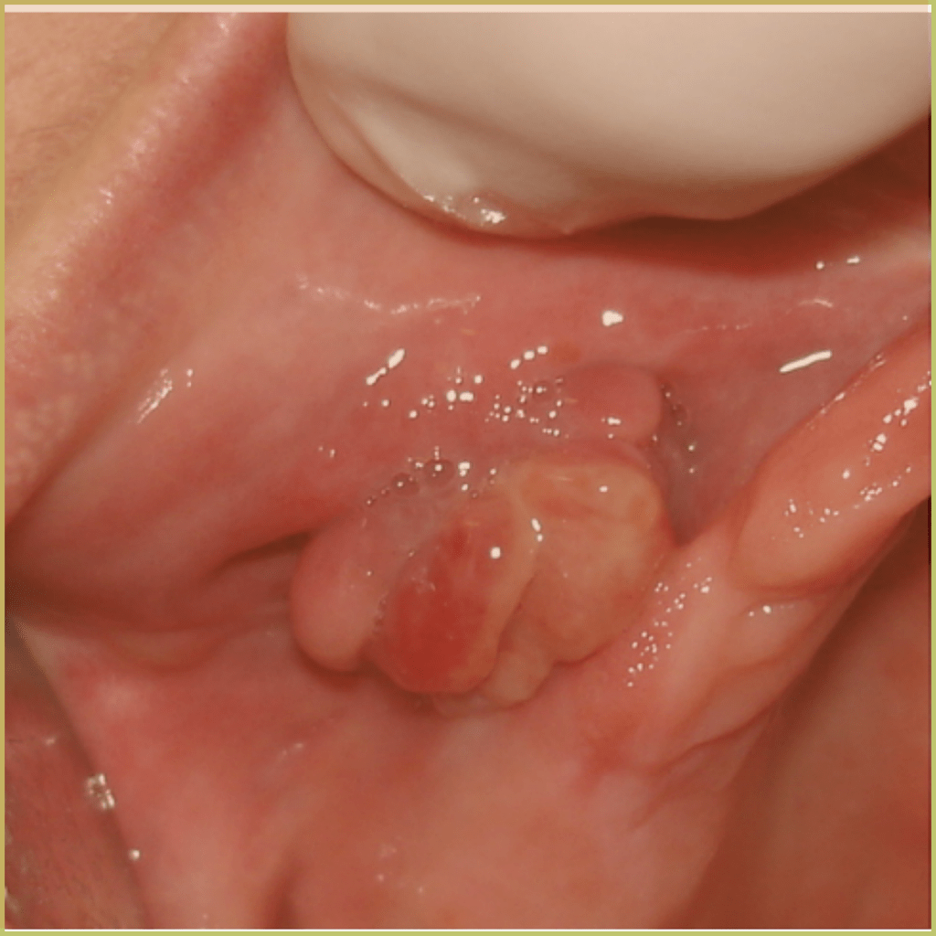 Fibrous Hyperplasia 1 1024x1024 1