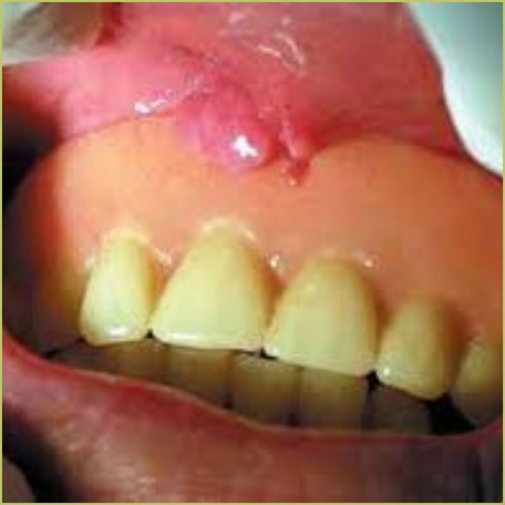 Fibrous hyperplasia 2 1024x1024 1