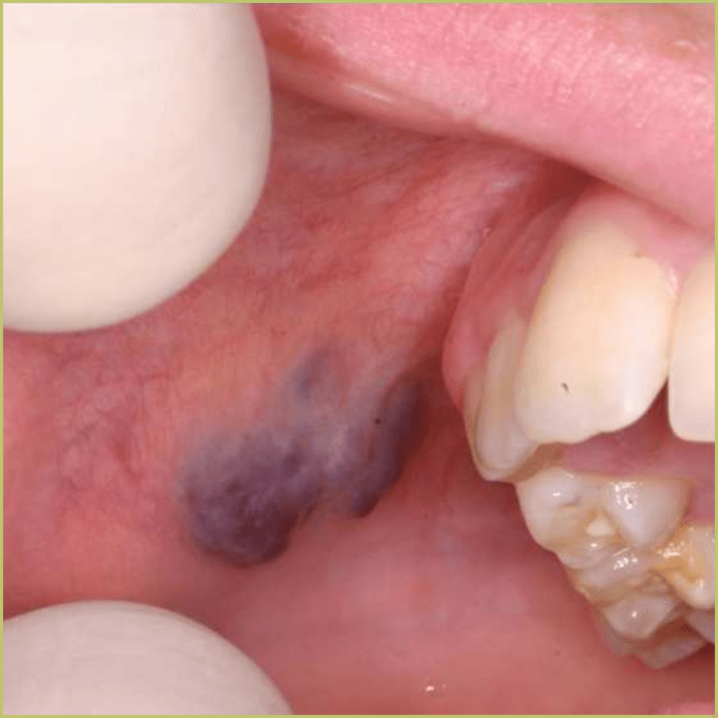 Figura 2 Hemangioma bucal lesao mais profunda 1 1024x1024 1
