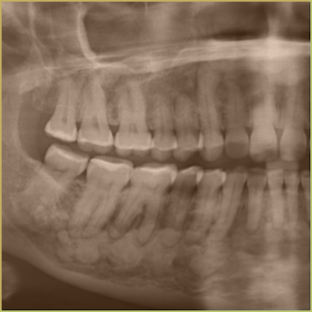 Florid Cemento osseous Dysplasia 1 1024x1024 1