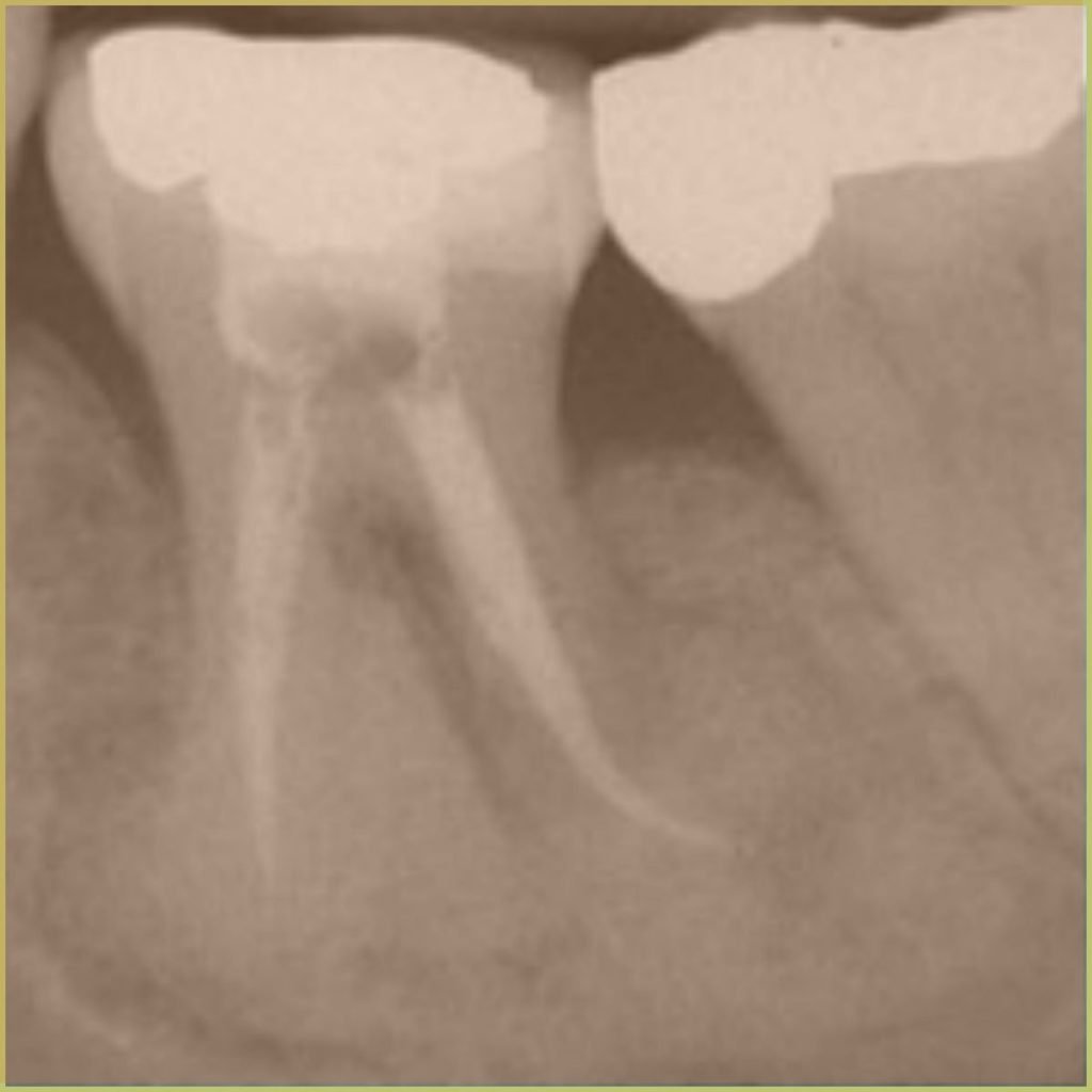 Florid Cemento osseous Dysplasia 2 1024x1024 1