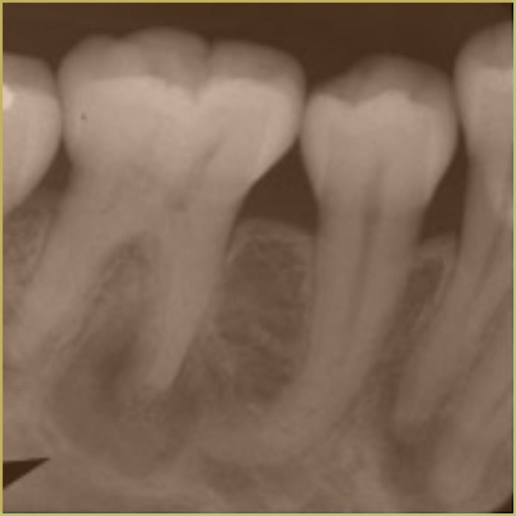 Florid Cemento osseous Dysplasia 3 1024x1024 1