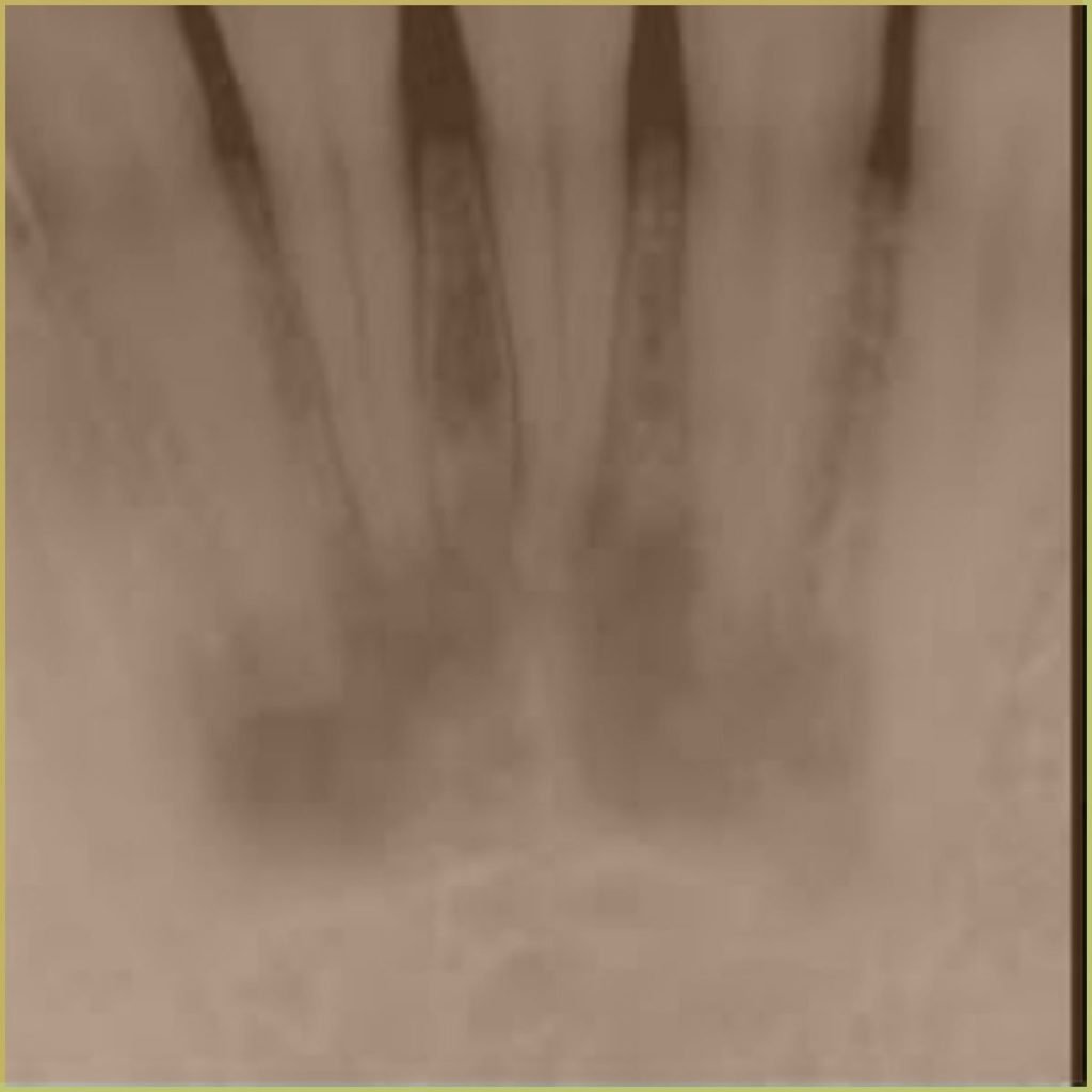 Florid Cemento osseous Dysplasia 4 1024x1024 1