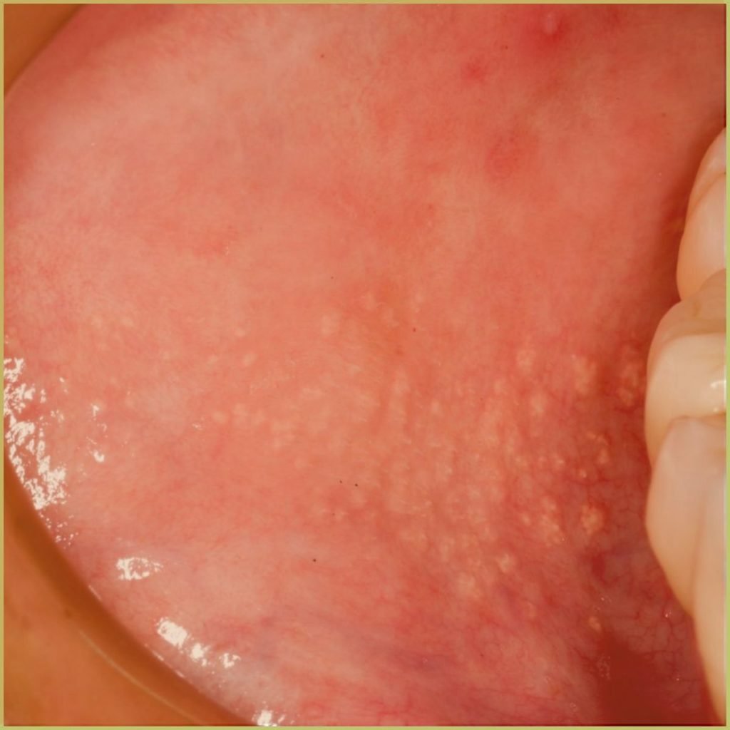 Fordyces Granules 1 1024x1024 1