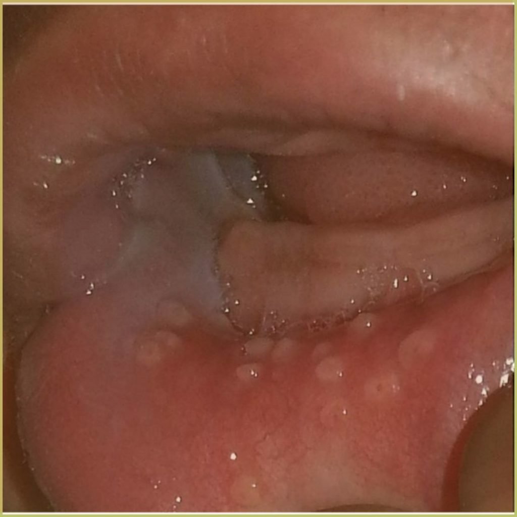 Fordyces Granules 2 1024x1024 1