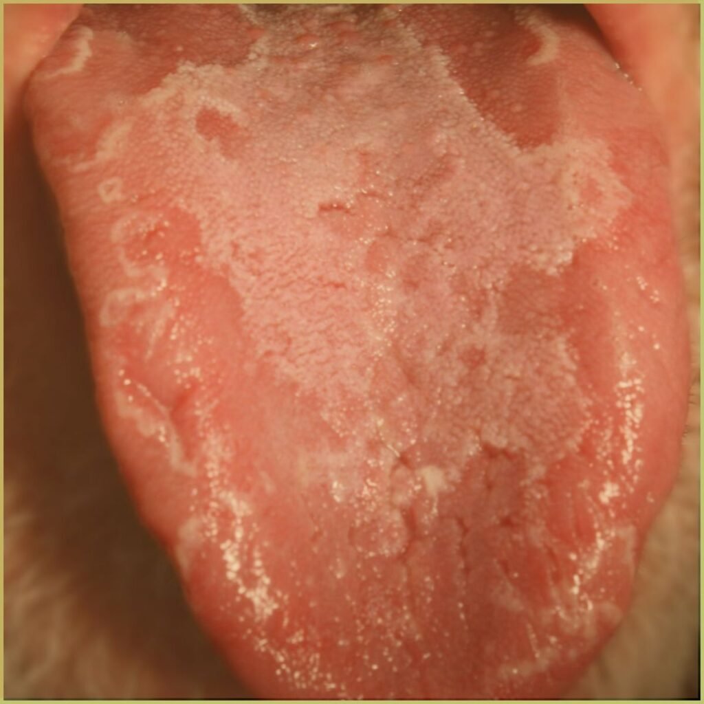 Geographic tongue 1