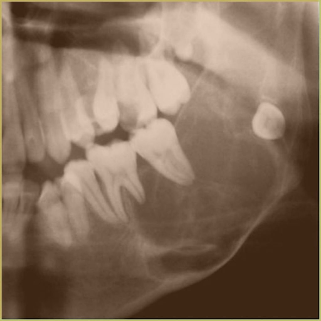 Giant Cell Granuloma 1 1024x1024 1
