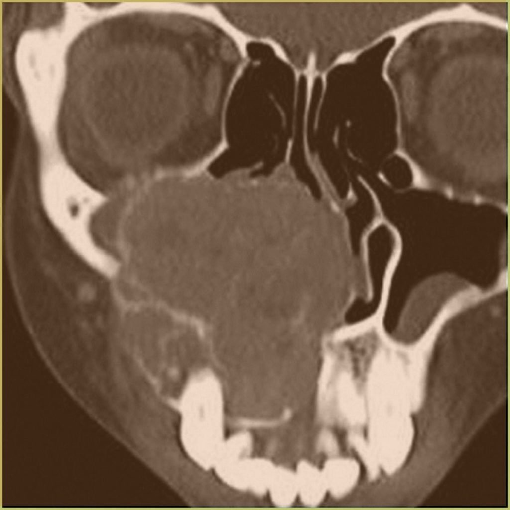 Giant Cell Granuloma 2 1024x1024 1