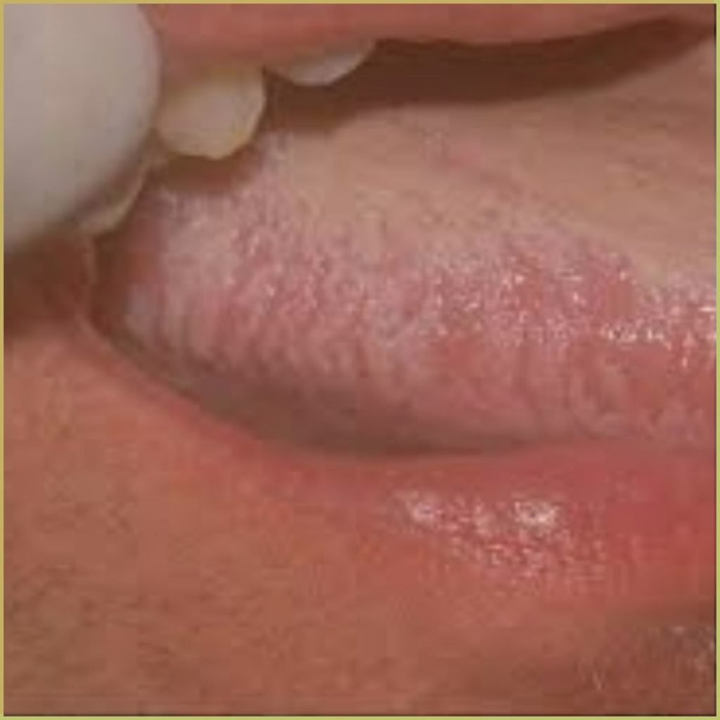 Hairy leukoplakia 1 1024x1024 1