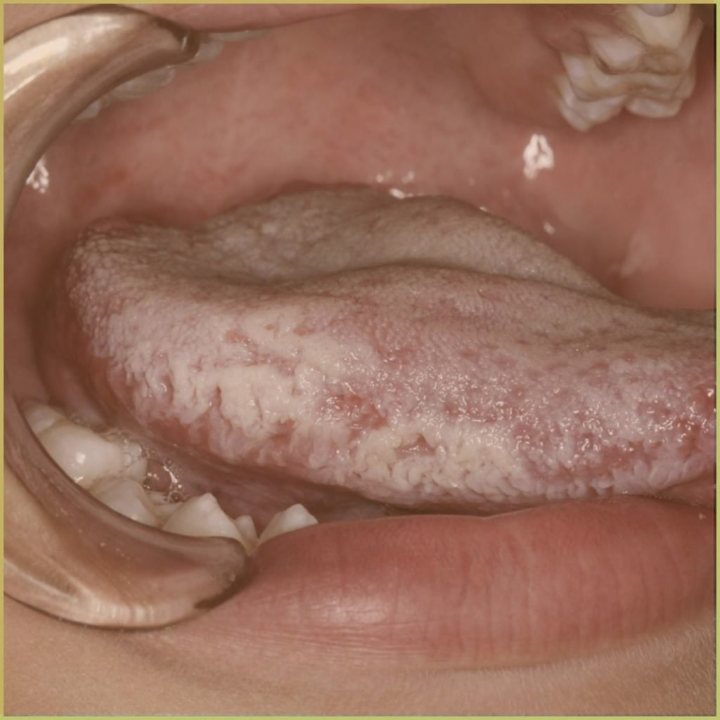 Hairy leukoplakia 2 1024x1024 1