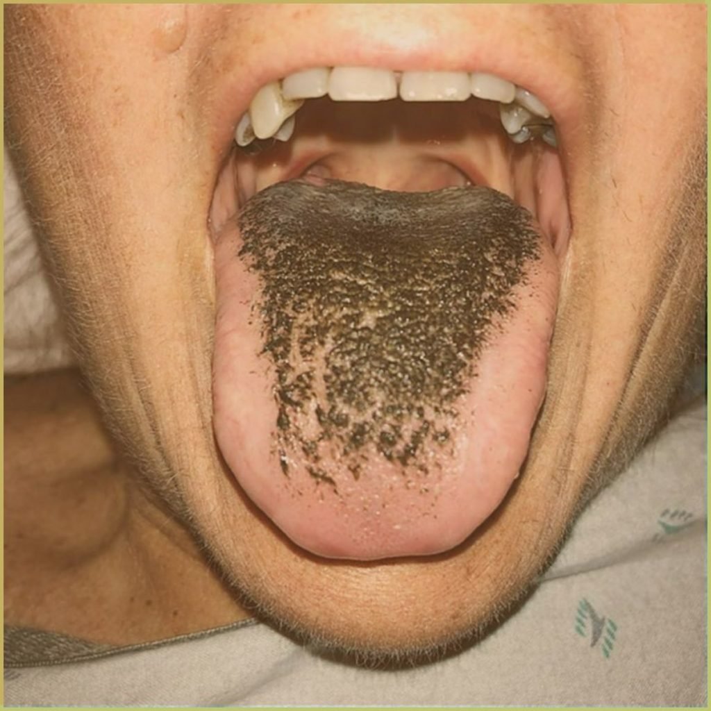 Hairy tongue 1 1024x1024 1