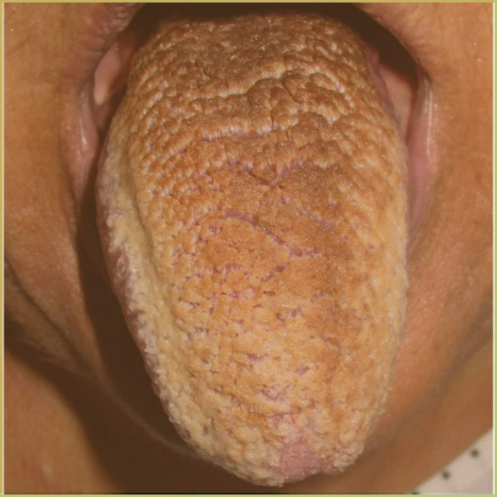 Hairy tongue 2 1024x1024 1