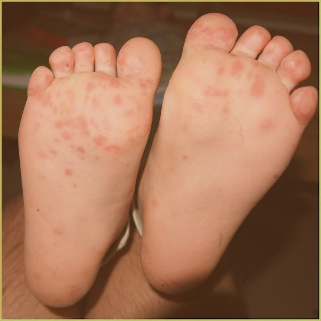 Hand Foot and Mouth Disease 1 1024x1024 1
