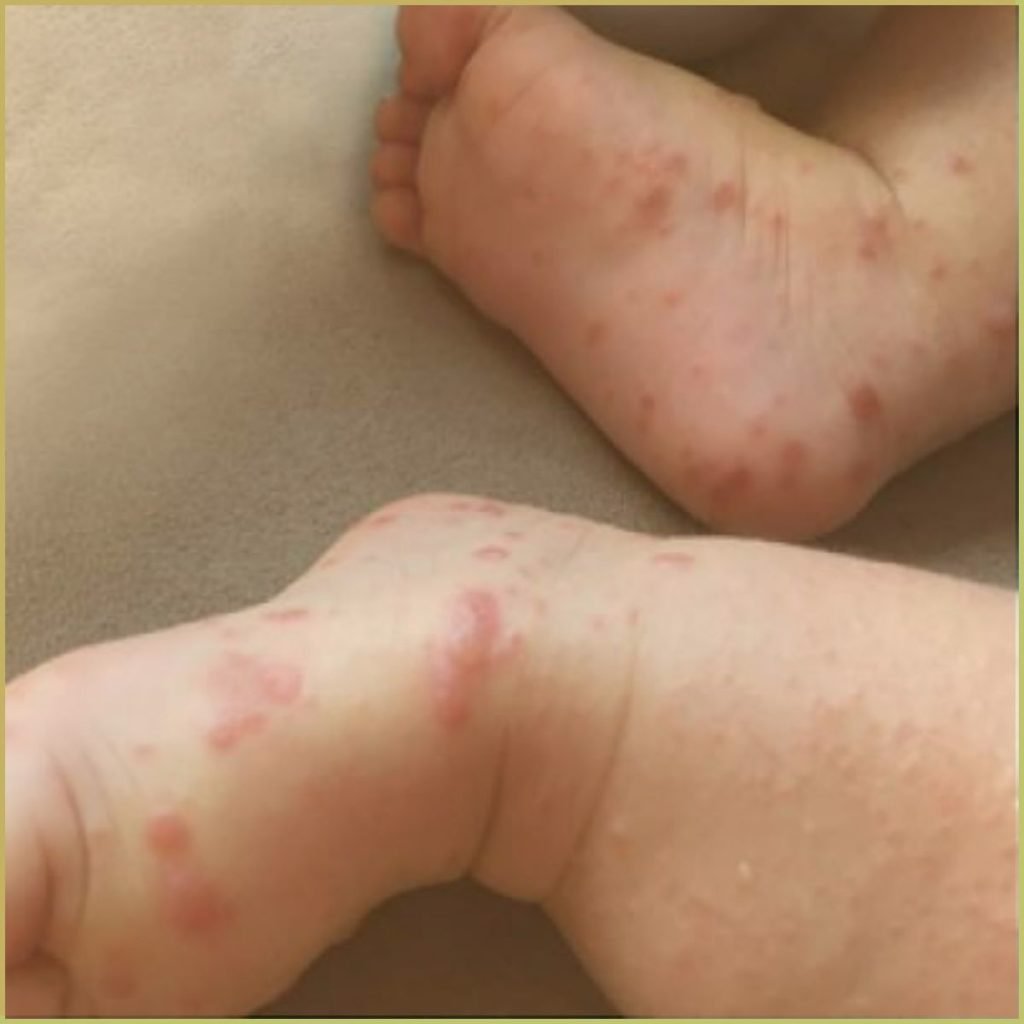 Hand Foot and Mouth Disease 2 1024x1024 1
